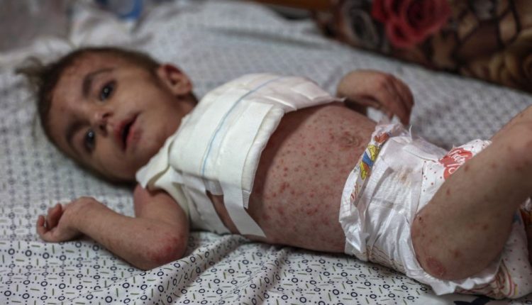 Neonatal babies suffer a lot